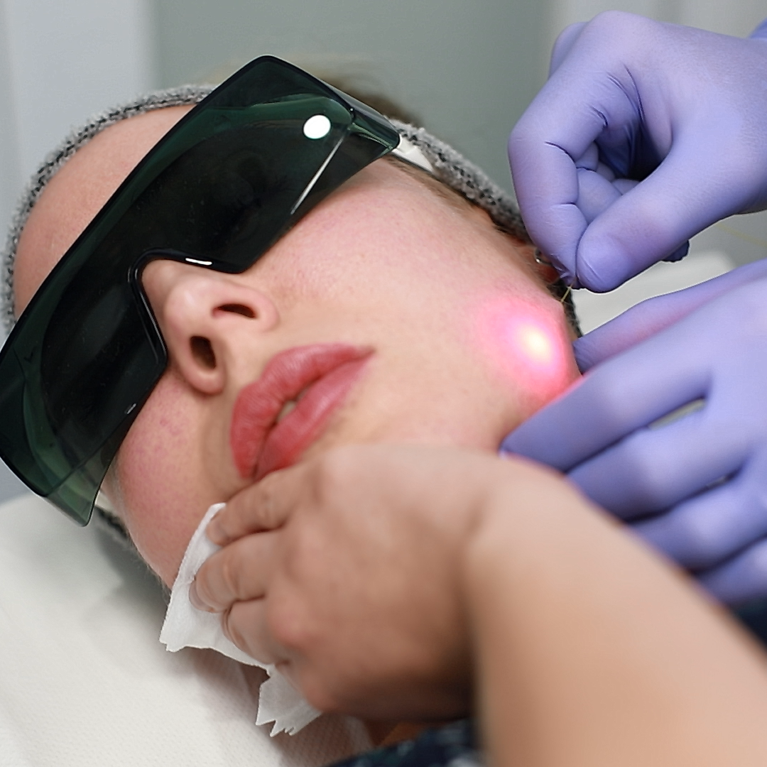 Endolift treatment at Ame So